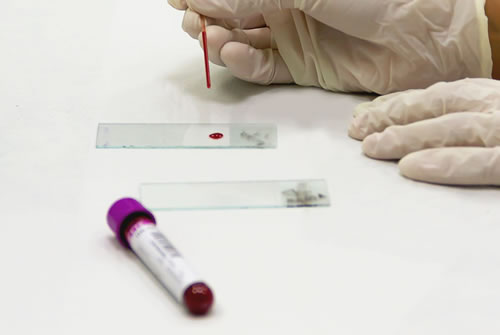 Gloved hands handle a blood sample and test tube for Shield colorectal cancer screening